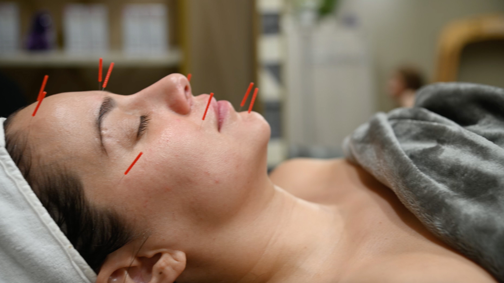 Cosmetic Accupuncture