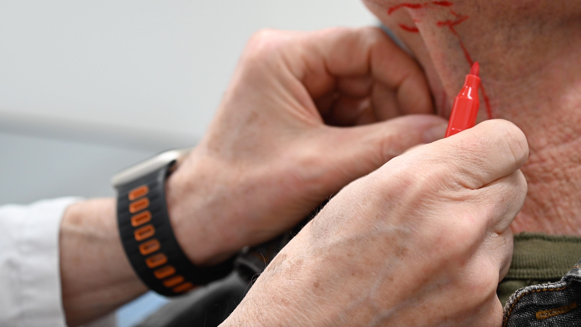 Cervicoplasty with Dr. Lloyd Hoffman